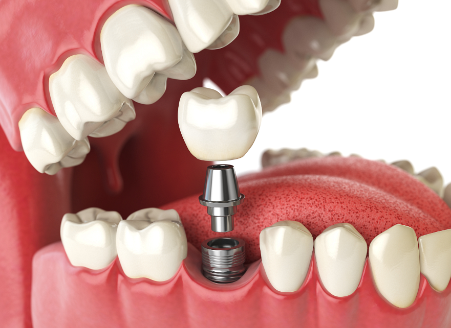 Ce avantaje oferă un implant dentar comparativ cu alte opțiuni?